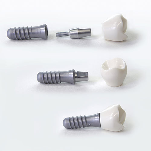 Zahnimplantate ‒ Alles was ma...