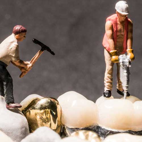 Zahnfüllungen im Vergleich: Z...